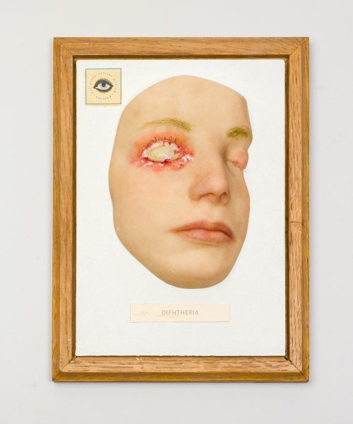 Moulage_Diphterie
