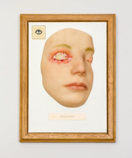 Flechtwerk_der_Dinge_Moulage_Diphterie